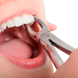 Extracción dental