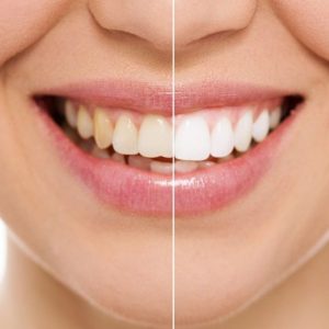 Blanqueamiento Dental